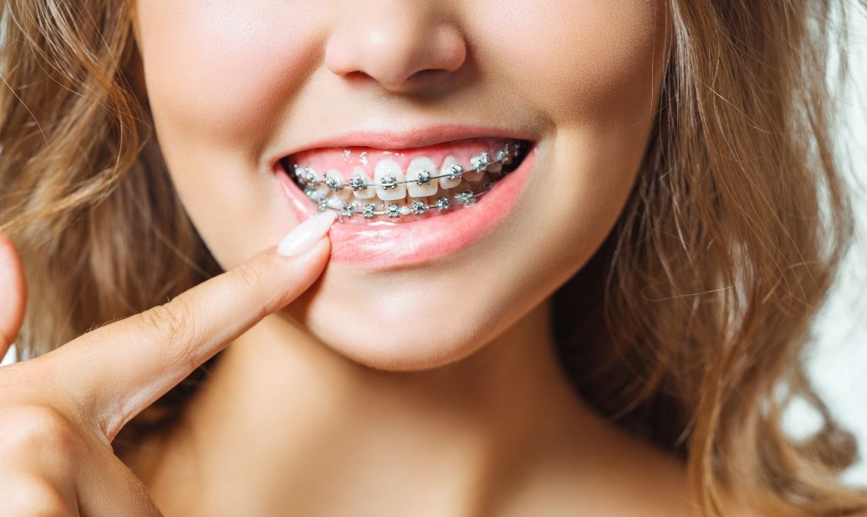 Aparelhos Fixos Convencionais e Estéticos